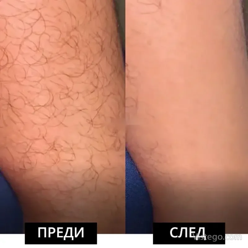 Кристал за премахване на окосмяване - 6